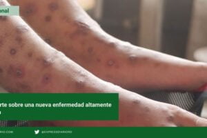 Surge en Haití una enfermedad altamente contagiosa similar a la sarna
