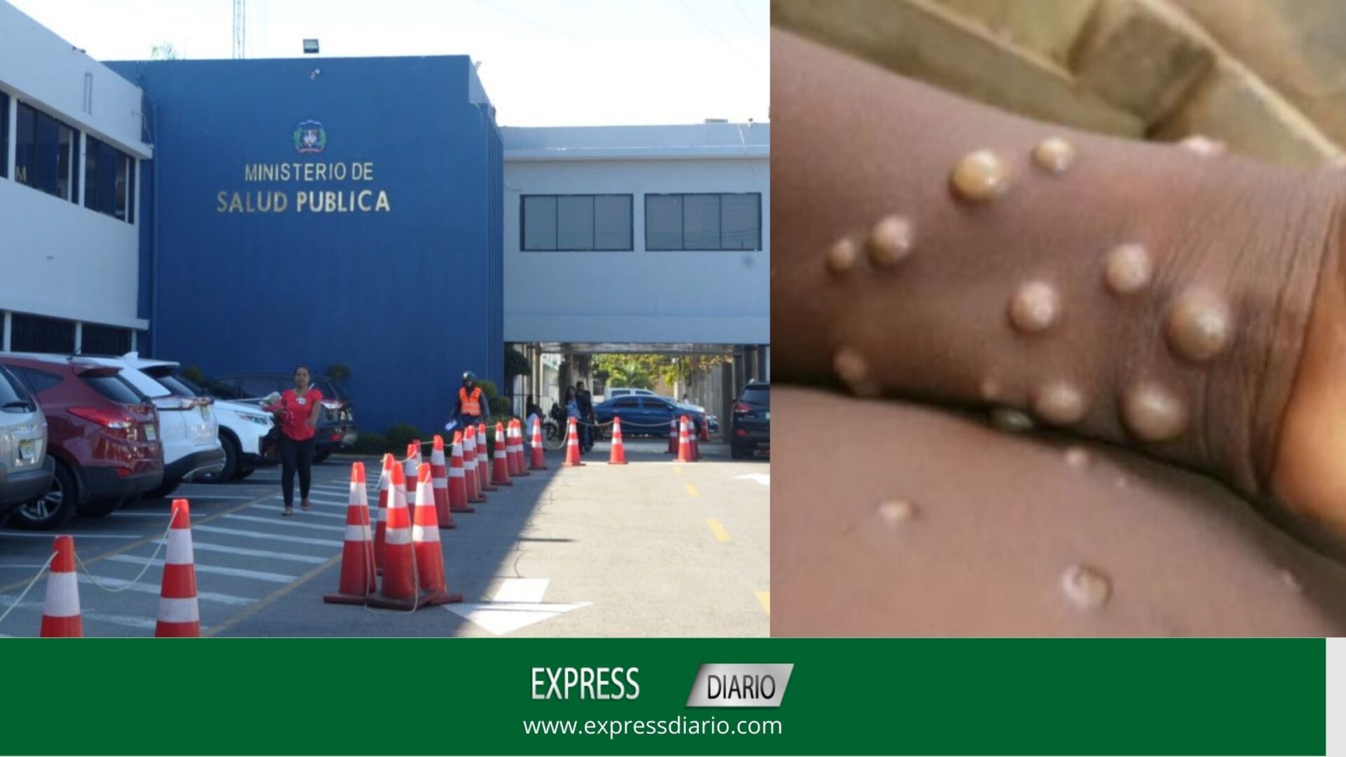 Ministerio de Salud Pública mantiene activa vigilancia por viruela del mono