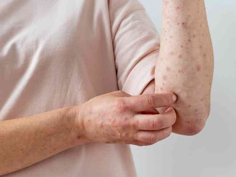 Los casos de viruela del mono han disminuido un 90 por ciento en los últimos tres meses