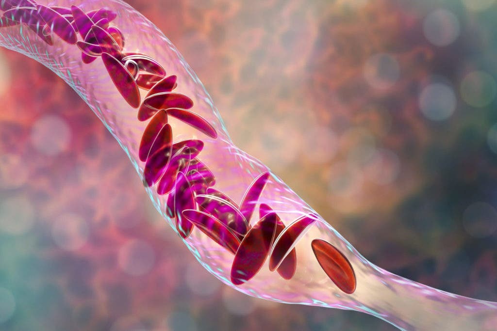 La nueva terapia génica para pacientes con enfermedad de células falciformes La nueva terapia génica para pacientes con enfermedad de células falciformes