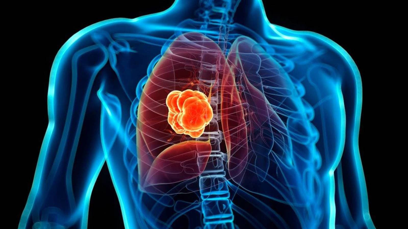 Un nuevo tratamiento aumenta la supervivencia en pacientes con cáncer de pulmón Un nuevo tratamiento aumenta la supervivencia en pacientes con cáncer de pulmón