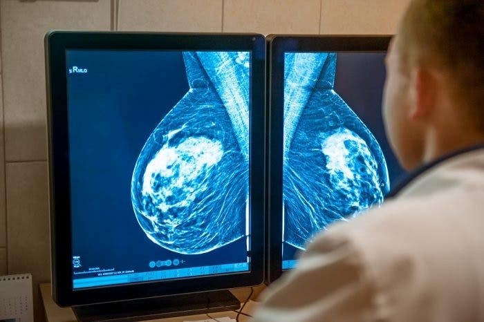 La innovación mejora la esperanza de vida en pacientes con cáncer de mama metastásico