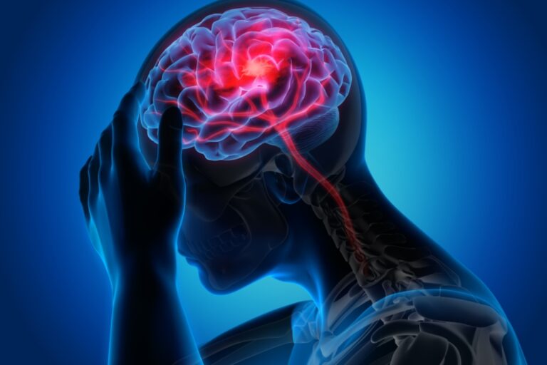 Identifican variantes genéticas que protegen contra la migraña para mejorar...