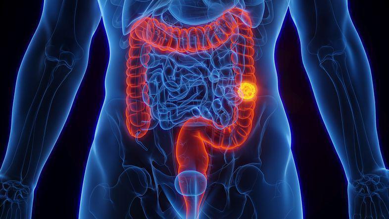 Cómo se explica el aumento de los casos de cáncer colorrectal entre las personas menores de 50 años Cómo se explica el aumento de los casos de cáncer colorrectal entre las personas menores de 50 años
