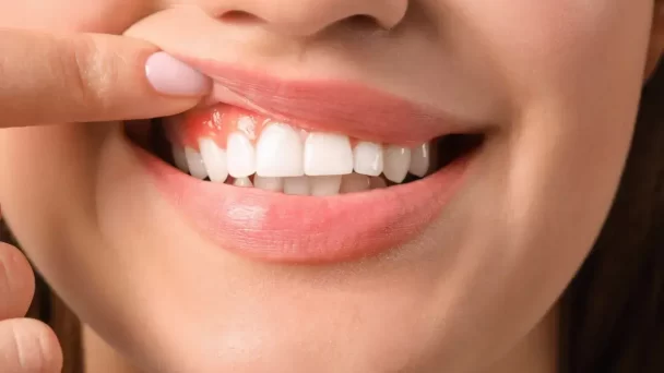 Diez mitos de la salud de las encías