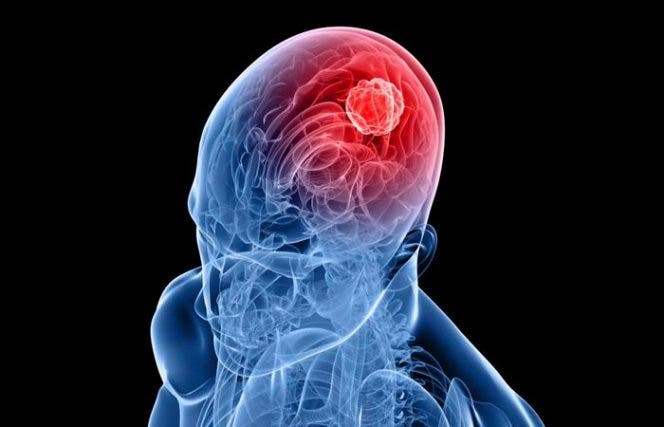 El bloqueo de dos genes germinales reduce el tamaño de tumores cerebrales El bloqueo de dos genes germinales reduce el tamaño de tumores cerebrales