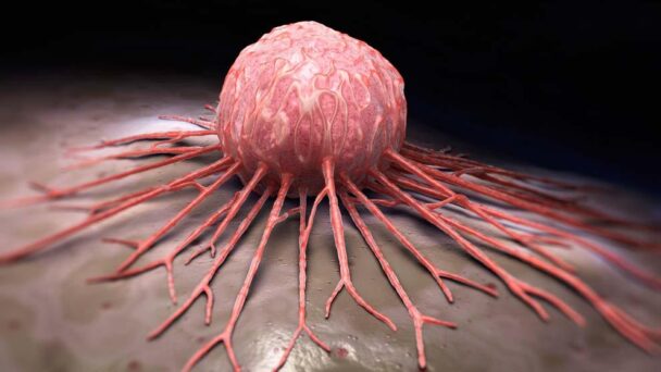 Mieloma múltiple: cáncer incurable a esperanza de vida para hasta 15% de los pacientes