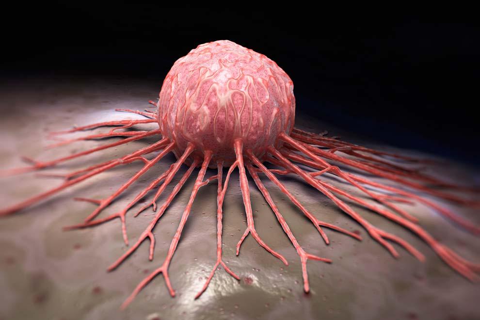 Mieloma múltiple: cáncer incurable a esperanza de vida para hasta 15% de los pacientes Mieloma múltiple: cáncer incurable a esperanza de vida para hasta 15% de los pacientes