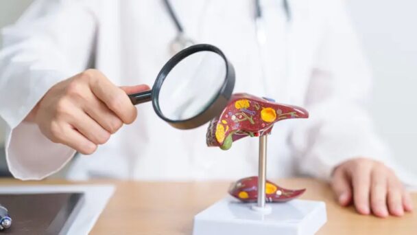 Obesidad y diabetes factores de aumento de la enfermedad hepática metabólica