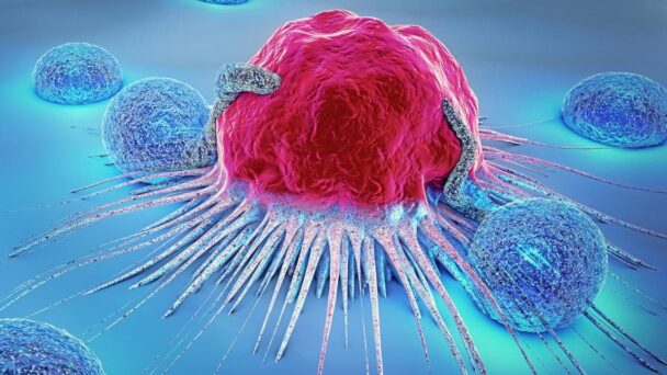 Recaída y metástasis, dos realidades del cáncer de mama