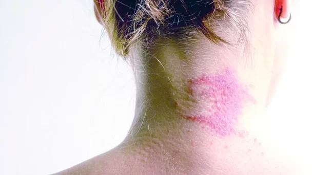 Dermatitis atópica;una de las patologías infantiles más comunes