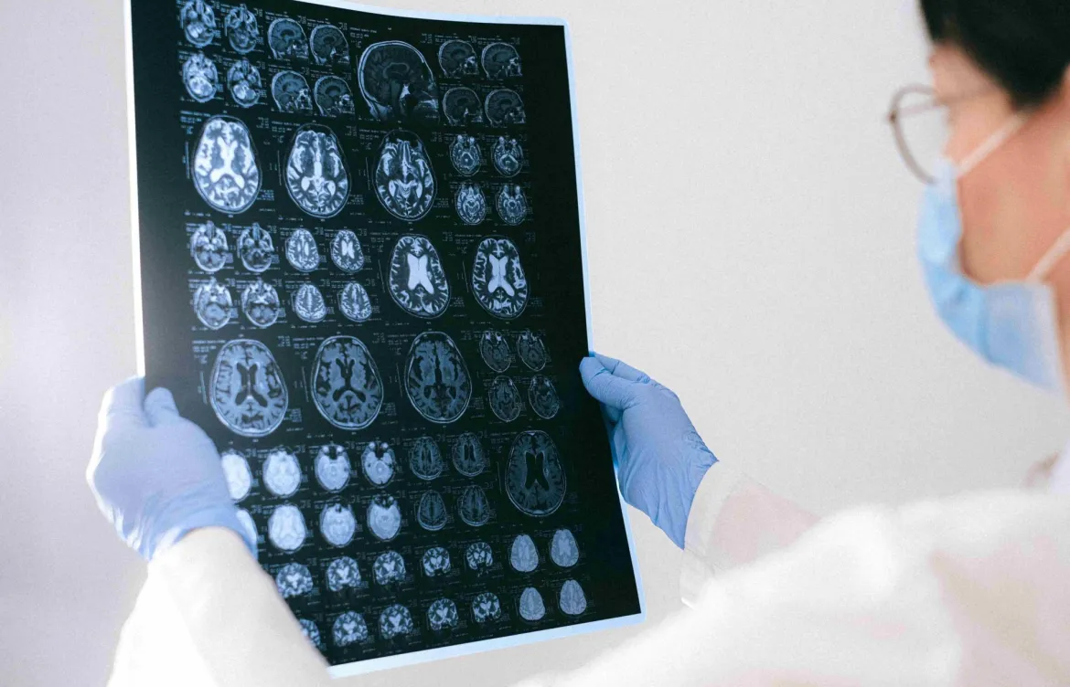 Controlar los factores de riesgo de epilepsia podría prevenir hasta un 30 % de los casos
