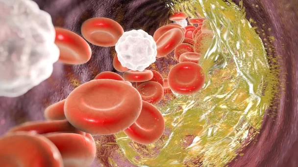 Enfermedad arterial coronaria puede presentarse de forma abrupta