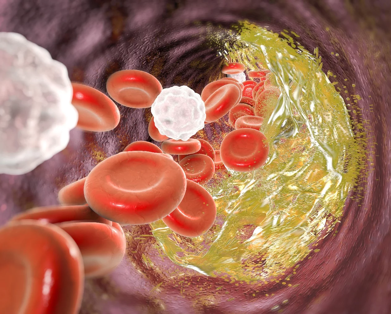 Enfermedad arterial coronaria puede presentarse de forma abrupta